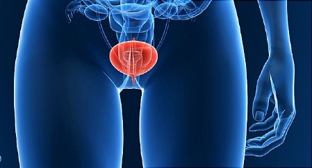 Incontinenta urinara, Vezica hiperactiva